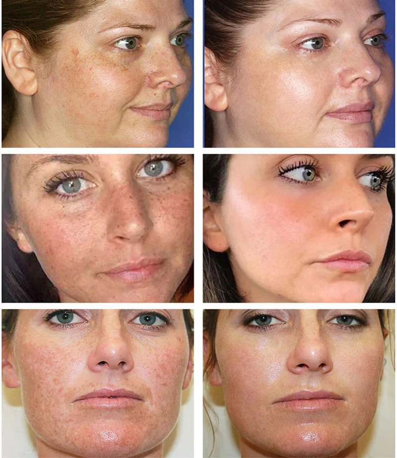 Мощный отбеливающий крем для у – обзор и цена Luxury Skincare Brands